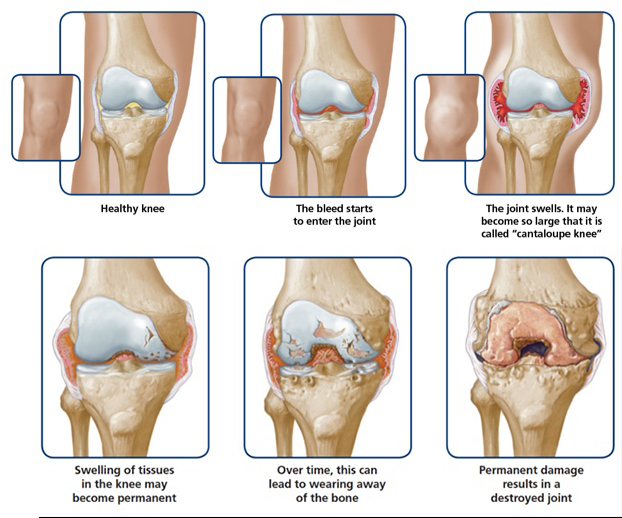 Diagram showing the damage done to a knee joint by repeated internal bleeding in the joint