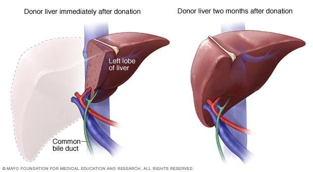 Illustration showing the speed with which even a severely resectioned liver can regrow