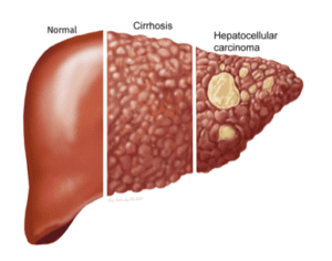 stages of liver damage